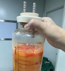 分宜水动力吸脂手术要做多久？